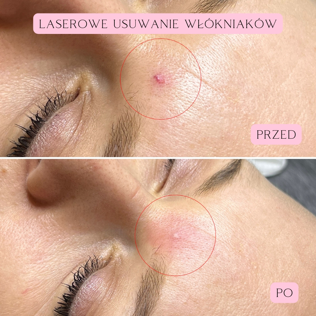 laserowe usuwanie włókniaków 03-2025