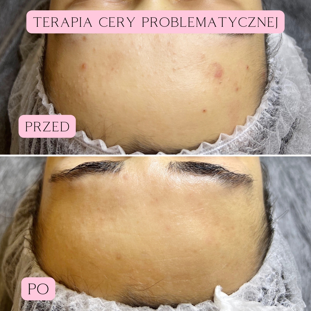 terapia nanili 03-2025 2