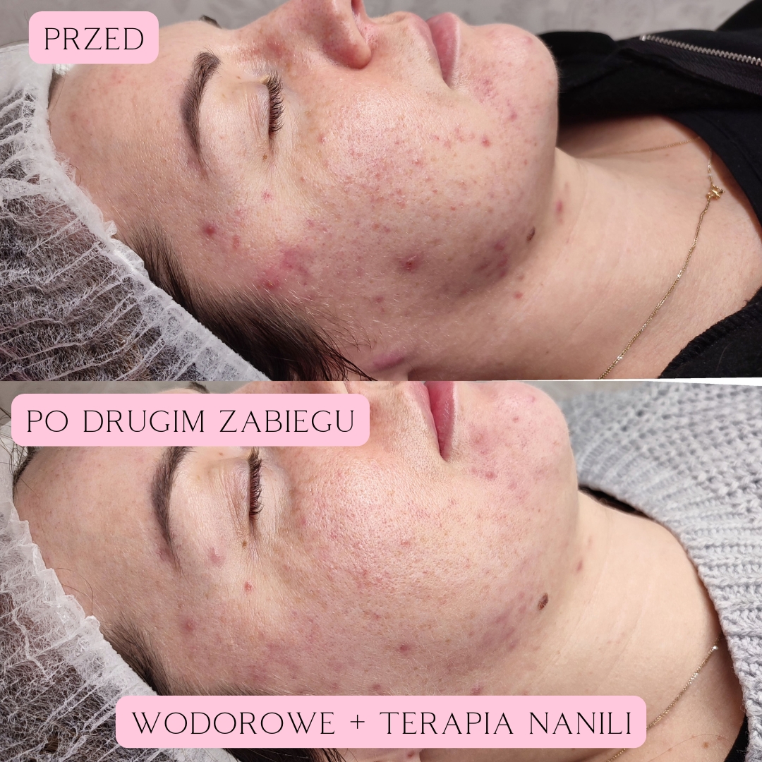 terapia nanili 03-2025 3