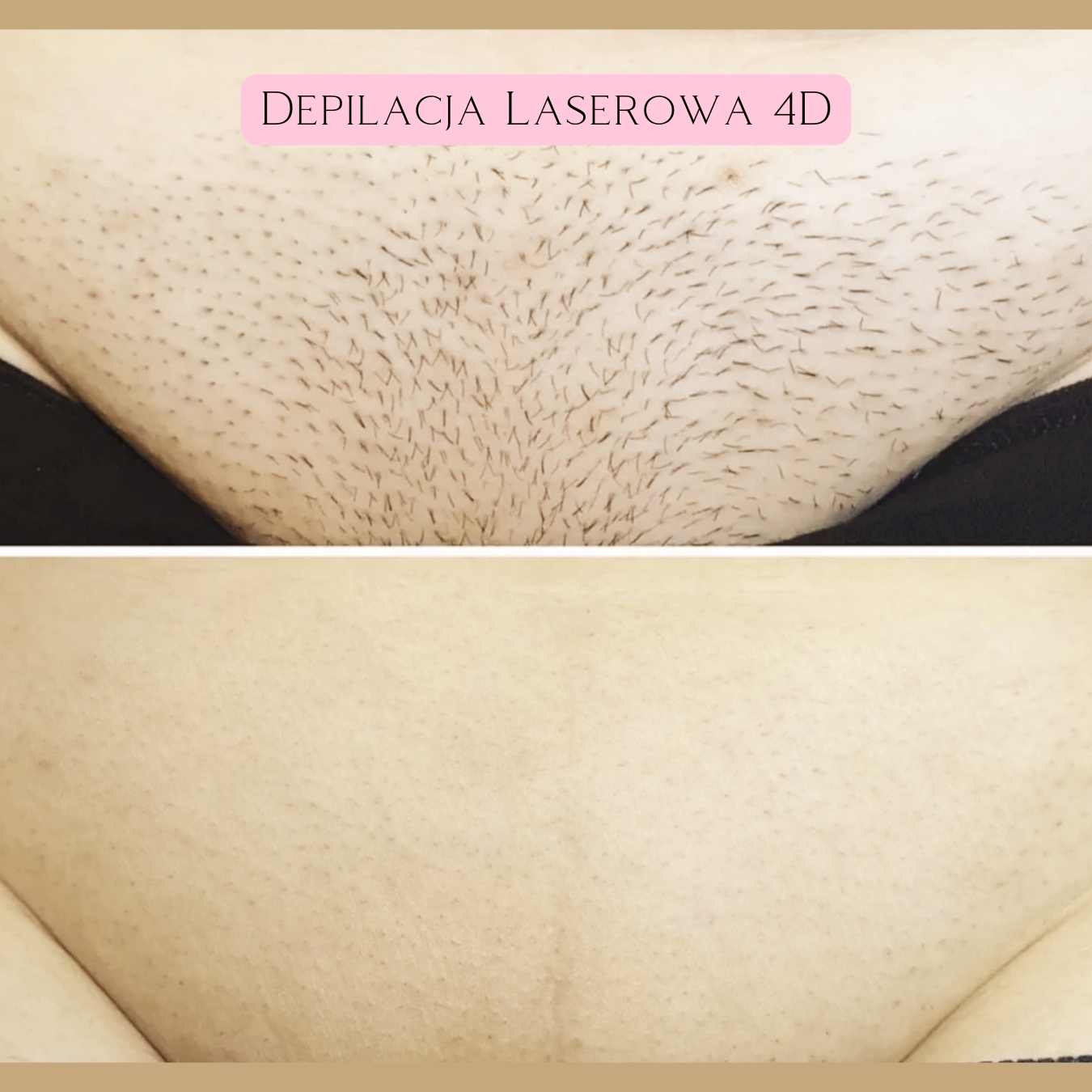 Depilacja Laserowa Efekty 20