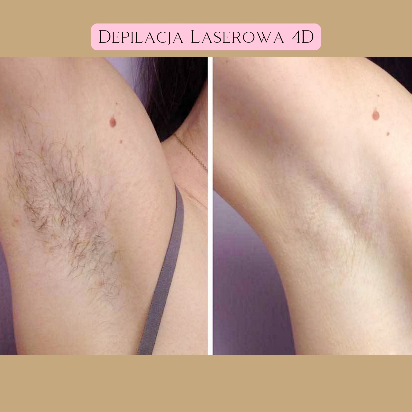 Depilacja Laserowa Efekty 21