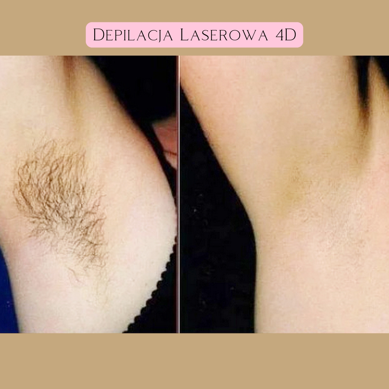 Depilacja Laserowa Efekty 22
