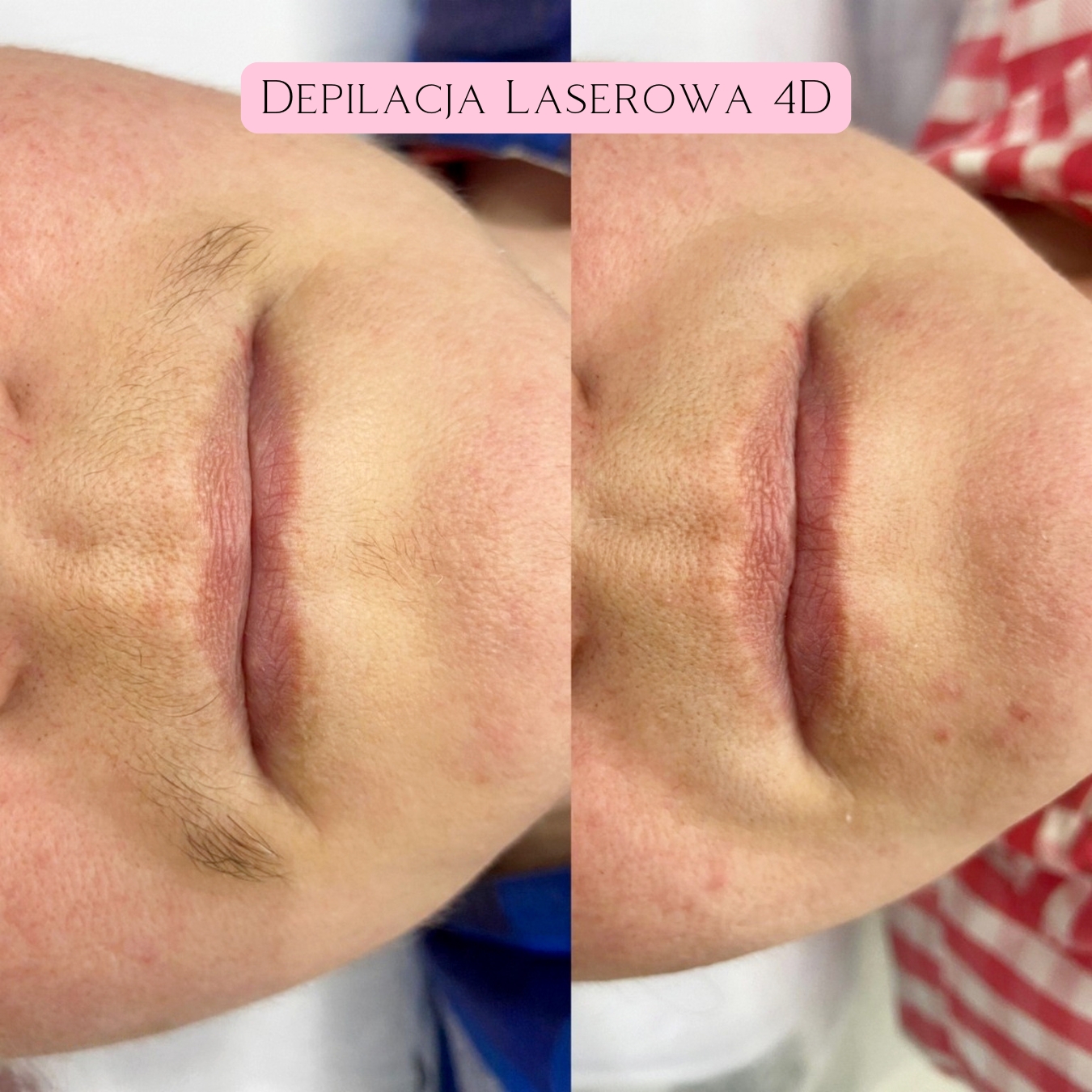 Depilacja Laserowa Efekty 23