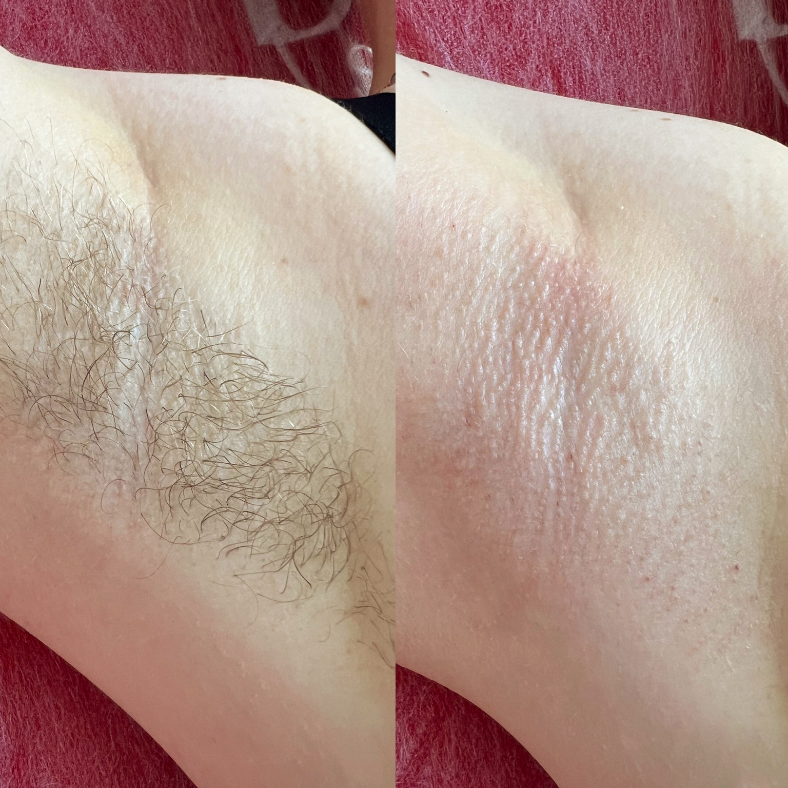 Depilacja Woskiem Efekty 2