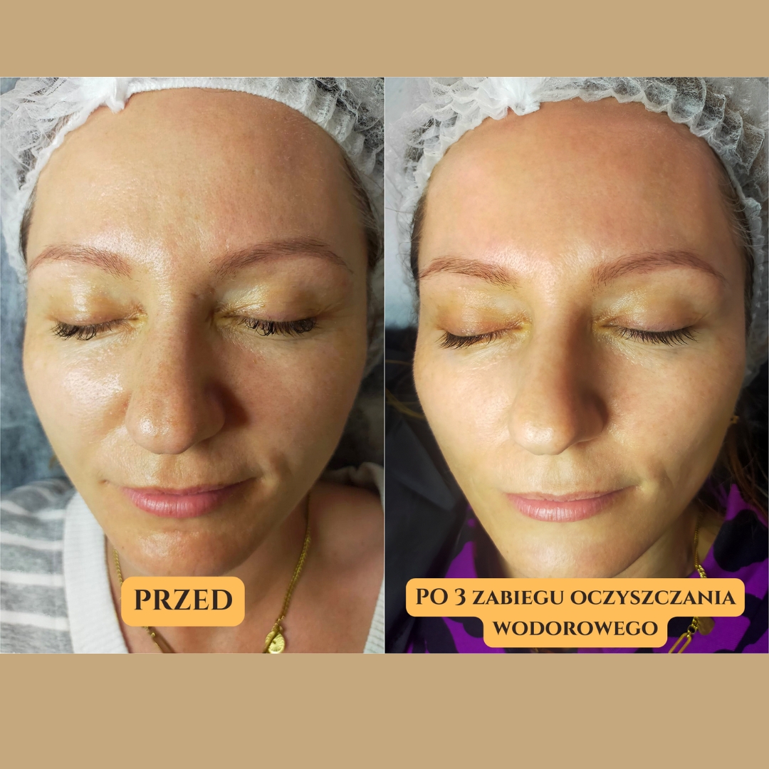 Oczyszczanie Wodorowe Efekty 3