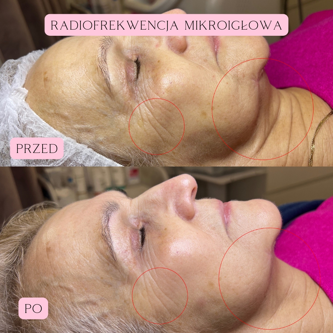 Radiofrekwencja mikroigłowa RF 1