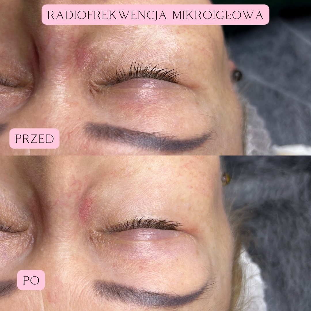 Radiofrekwencja mikroigłowa RF 6