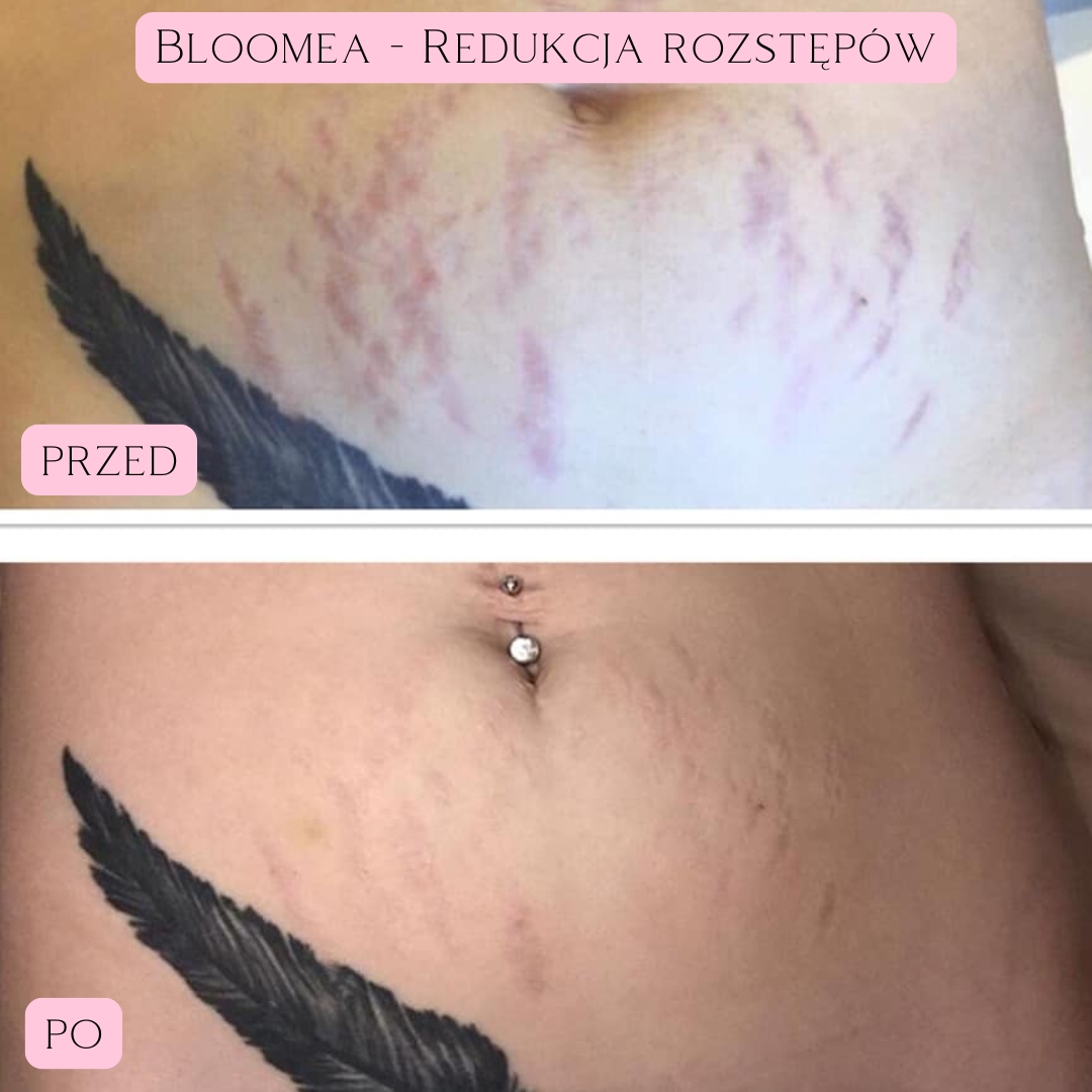 Redukcja blizn i rozstępów Bloomea 1