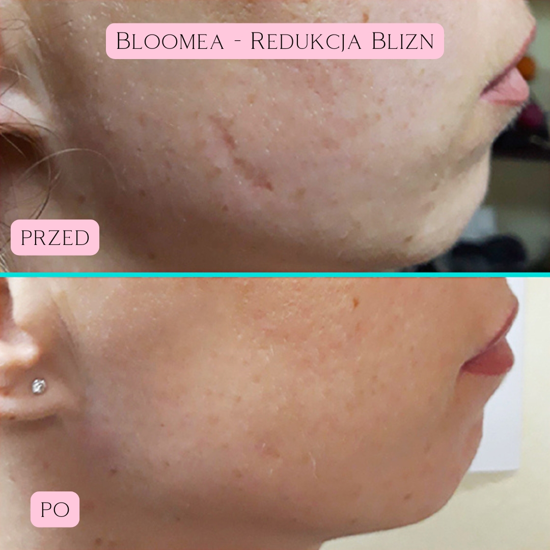 Redukcja blizn i rozstępów Bloomea 2