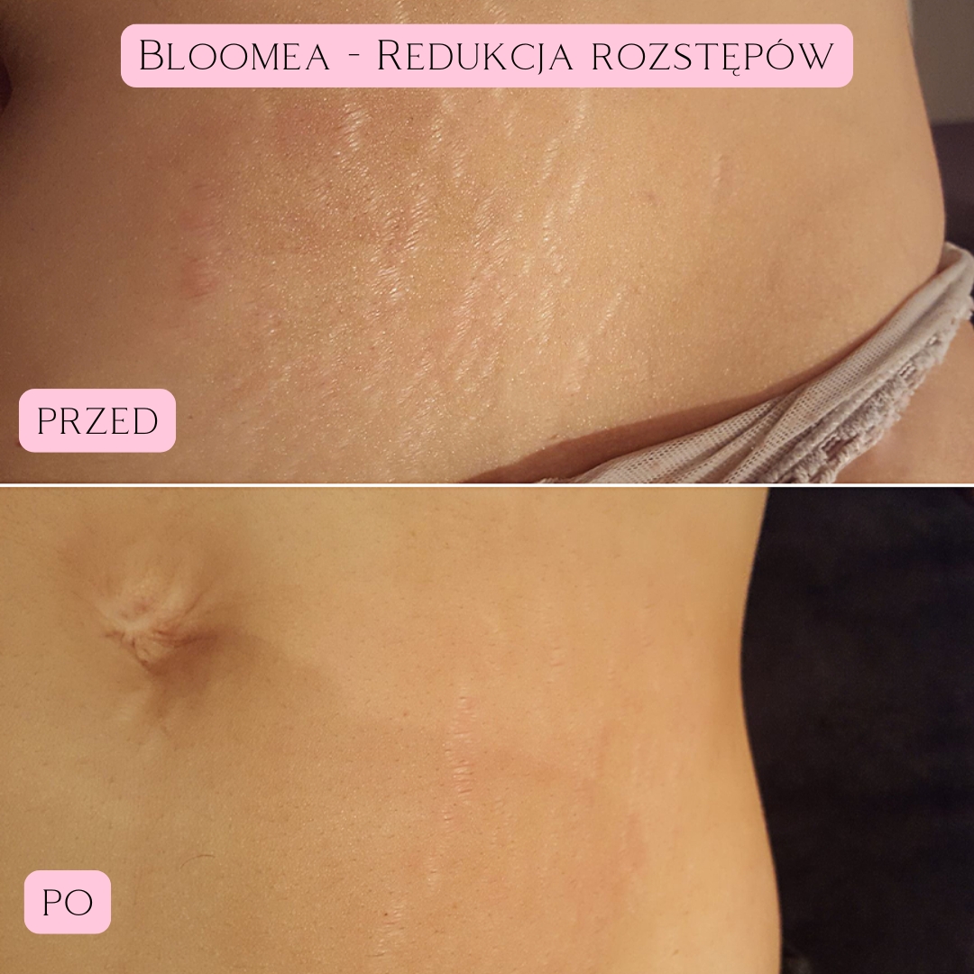 Redukcja blizn i rozstępów Bloomea 3