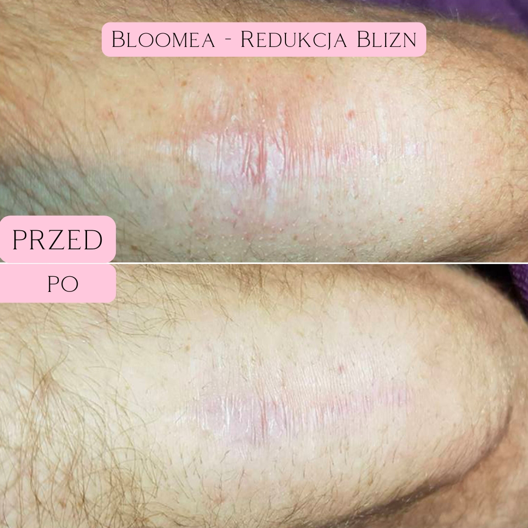 Redukcja blizn i rozstępów Bloomea 5