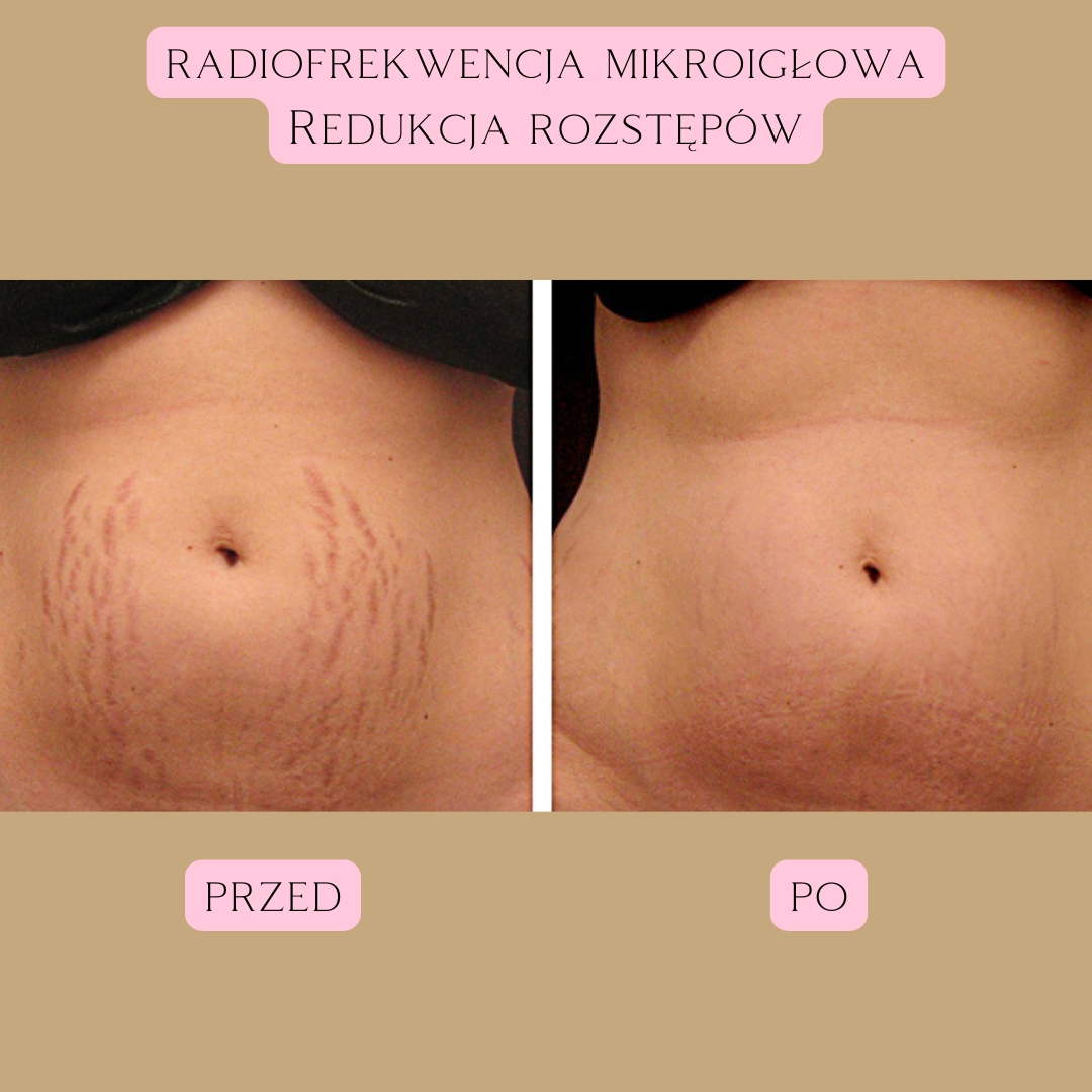 Redukcja blizn i rozstępów Radiofrekwencja 1