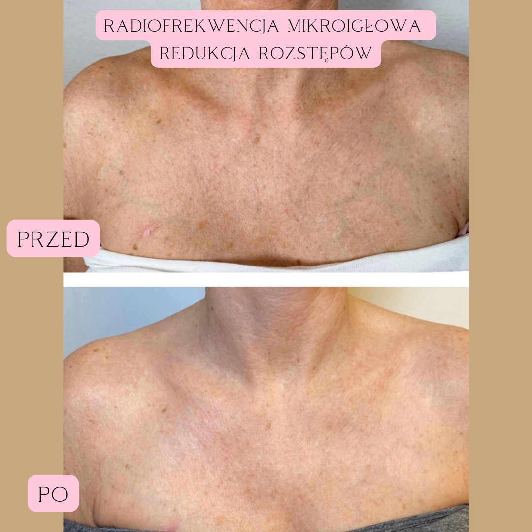Redukcja blizn i rozstępów Radiofrekwencja 2