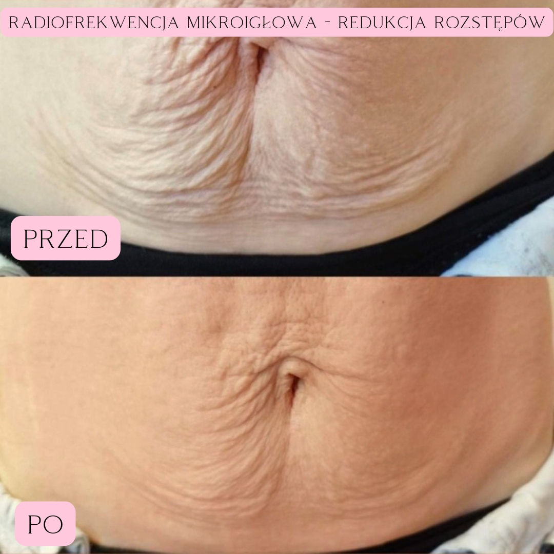 Redukcja blizn i rozstępów Radiofrekwencja 3