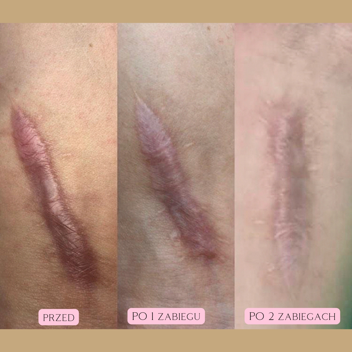 Redukcja blizn i rozstępów Radiofrekwencja 4