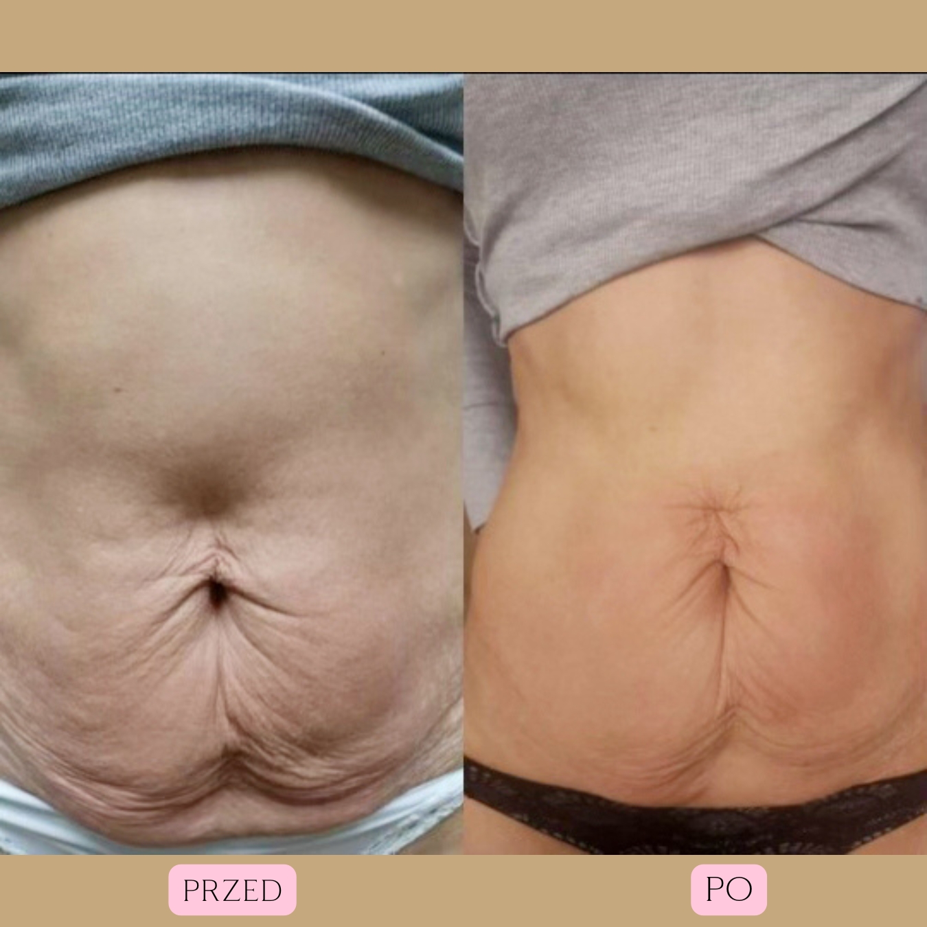 Redukcja blizn i rozstępów Radiofrekwencja 5