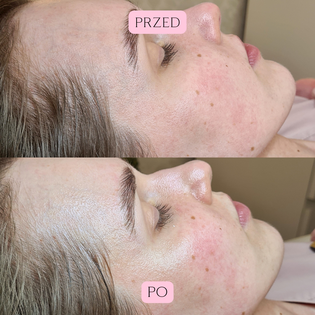 Sping Love - zabieg rewitalizujący (1)