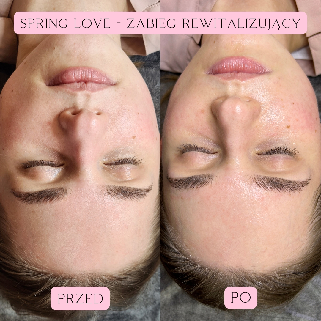 Sping Love - zabieg rewitalizujący (2)
